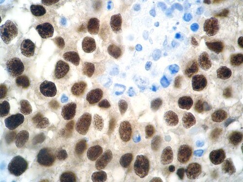 IHC of OCT-4 on an FFPE Seminoma Tissue